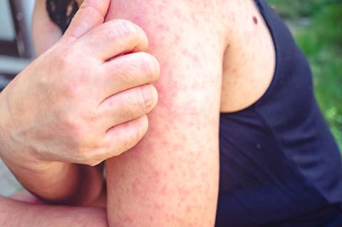 A young woman with the measles itches the rash on her arm.